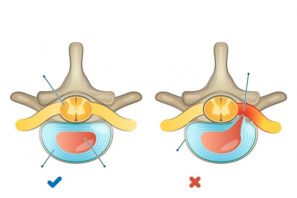 intervertebral discs - one healthy, the other with a herniation