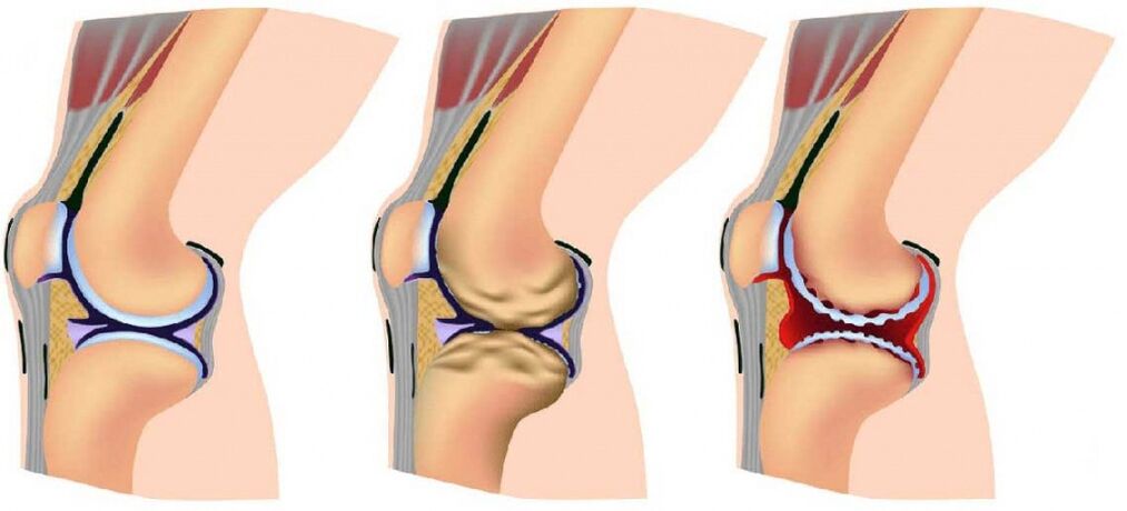 Healthy joint and affected by arthrosis