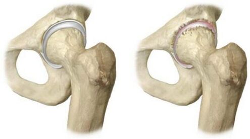 healthy and arthrosis-affected hip joint